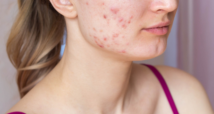 Can Fragrance Cause Breakouts of Acne 2]